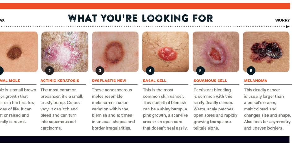 warts and skin cancer