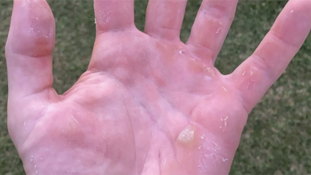 Viktor Hovland's hand looks like he stuck it in a sausage ...