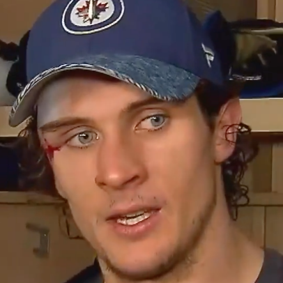 Winnipeg Jets' Morgan Barron gets 75 stitches after getting cut by skate,  returns to game