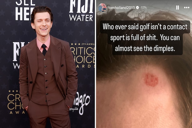 actor-tom-holland-shares-photo-of-huge-welt-on-his-forehead-from-golf-course-mishap