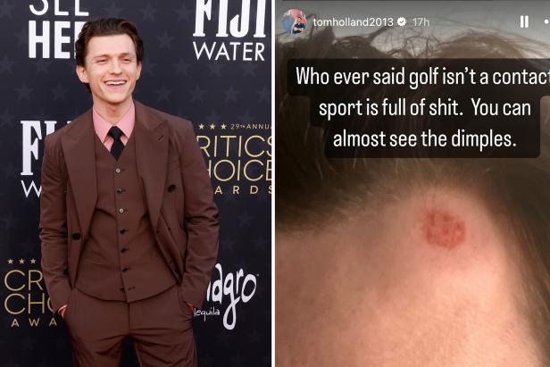 Actor Tom Holland shares photo of huge welt on his forehead from golf-course mishap